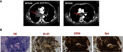 Long-term survival with a combination of immunotherapy, anti-angiogenesis, and traditional radiotherapy in brain metastatic small cell lung cancer: a case report